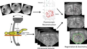 Brachytherapy